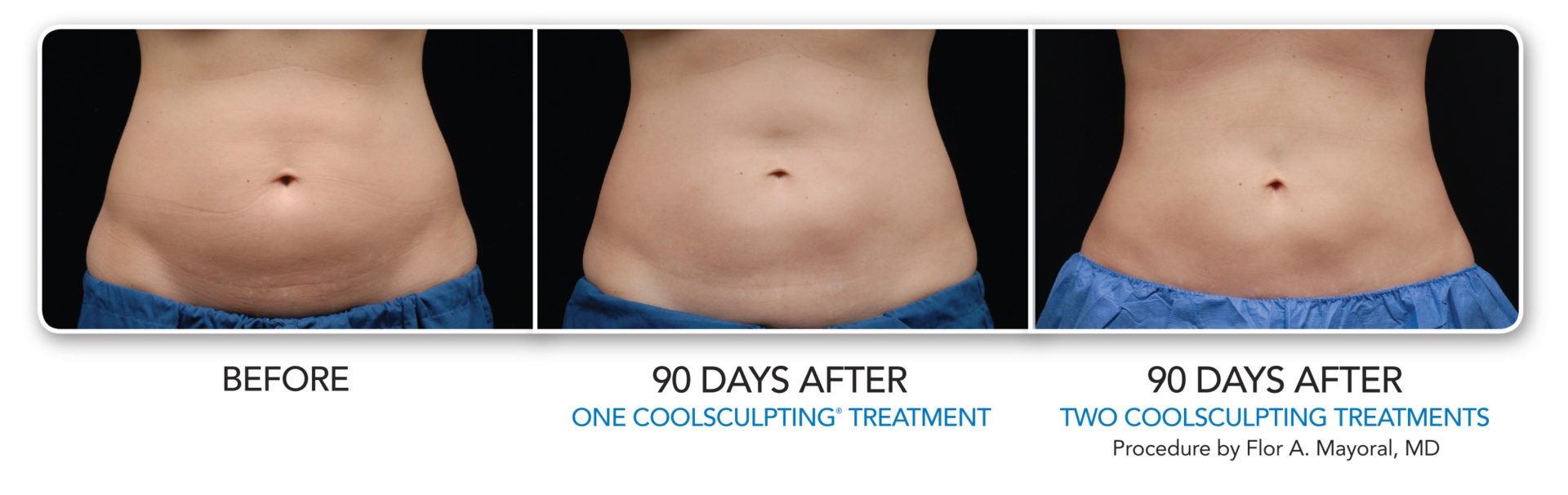 CoolSculpting Dr. Quardt Medical Spa Rancho Mirage Palm Springs
