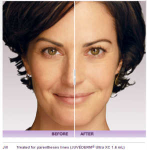 Juvéderm® Collection Of Fillers - Dermal Filler - Allergan ... Can Be Fun For Anyone thumbnail