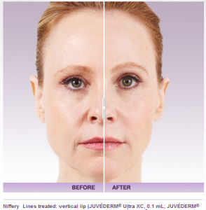 Juvederm Voluma