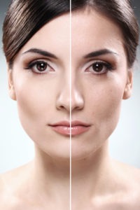 Laser Skin Resurfacing Treatments to Reduce Aging