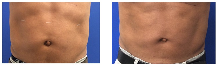 VelaShape II Body Contouring, Medical Spa