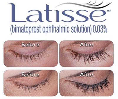 Lash Growth Products, Latisse for Eyelashes