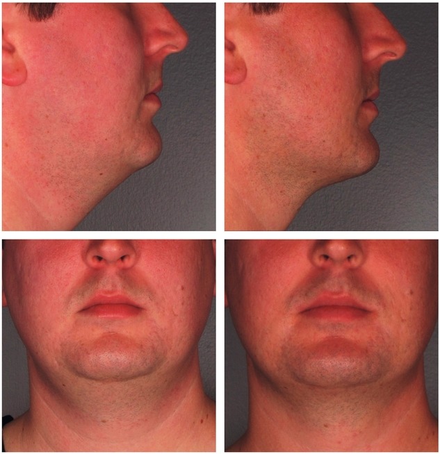 More Men Seeking Non-Surgical Double Chin Reduction