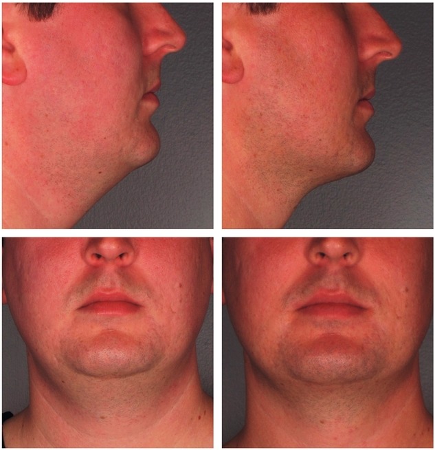 Kybella Injections For Double Chin Reduction Before After Photo 