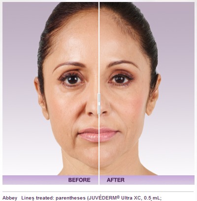 Liquid Facelift with Restylane, Voluma, &#038; Juvederm