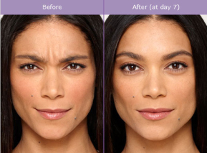 Botox vs. Dysport | Plastic Surgery | Palm Desert | Rancho Mirage