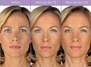 Botulinum Toxin Procedure Steps