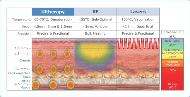 What is Ultherapy Skin Tightening?