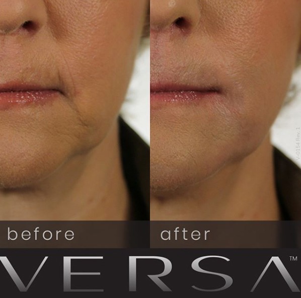 Revanesse Versa Dermal Filler Before And After Photos 