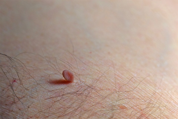 Closed Up of Skin Tags or Acrochordon Under the Armpit Stock Photo