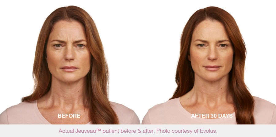 Jeuveau Injections to Reduce Wrinkles Before And After Photos