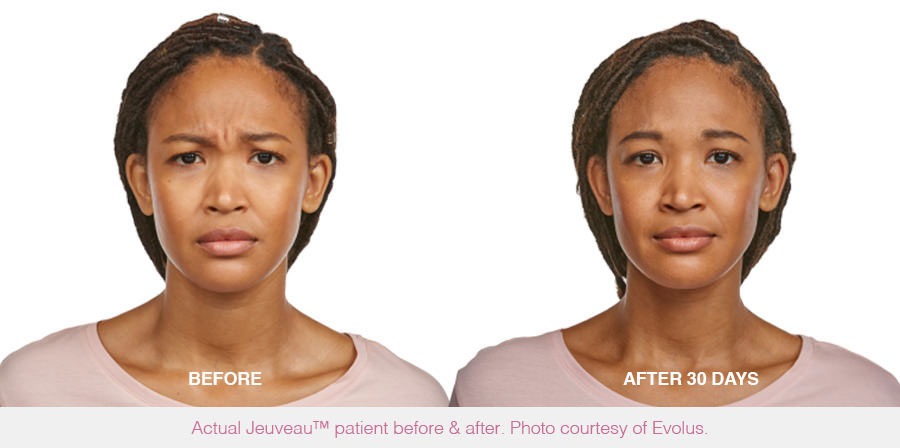 Jeuveau Injections to Reduce Wrinkles Before And After Photos