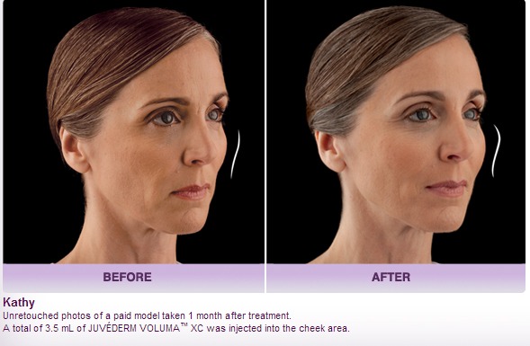 Juvéderm Voluma Dermal Filler Before After Photos Palm Springs Ca Rancho Mirage