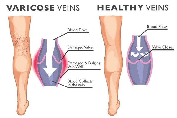 3 Ways to Prevent Varicose Veins After Your Procedure - Summit Skin Care