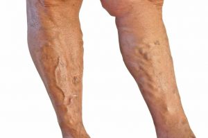 Varicose Vein Treatment