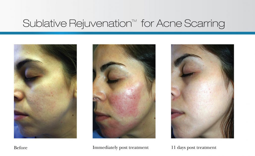 eMatrix Sublative Skin Rejuvenation | Laser Skin Resurfacing Before And After Photos