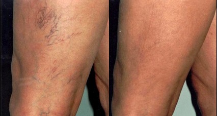 Spider Vein Removal Before and After Pictures