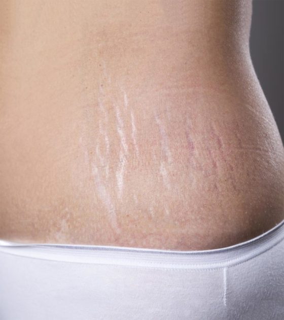 Get Rid Of Stretch Marks