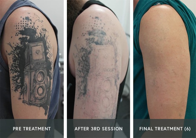 Tattoo removal southern california