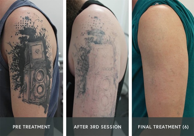 11 things you need to know about tattoo removal  Glamour UK