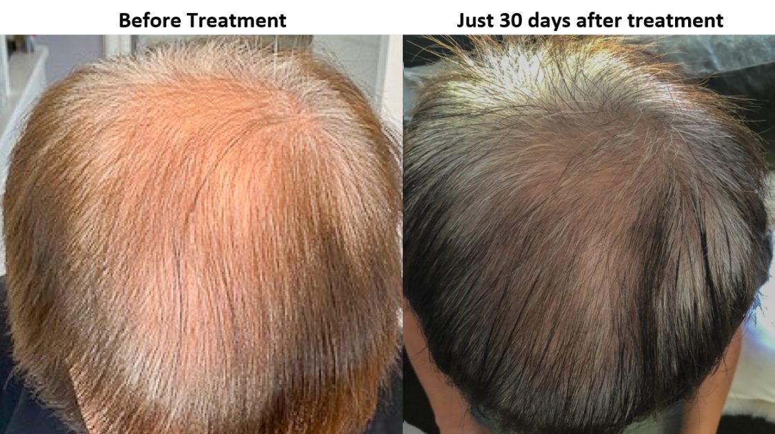 EXOSOME Treatments Hydrate, Nourish The Scalp for Hair Growth Palm Springs  CA
